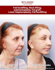Before and after deep plane facelift results at Returning Plastic Surgery, visible facial rejuvenation