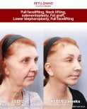 Before and after deep plane facelift results at Returning Plastic Surgery, visible facial rejuvenation
