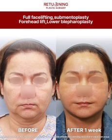 Before and after deep plane facelift, submentoplasty, forehead lift at Returning Plastic Surgery