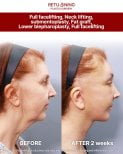 Before and after deep plane facelift results at Returning Plastic Surgery – visible facial lift