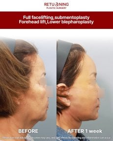 Before and after deep plane facelift, submentoplasty, and blepharoplasty at Returning Plastic Surgery