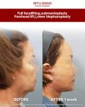 Before and after deep plane facelift, submentoplasty, and blepharoplasty at Returning Plastic Surgery
