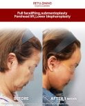 Before and after deep plane facelift, submentoplasty, and blepharoplasty at Returning Plastic Surgery
