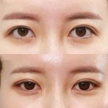 Результати блефаропластики до і після в Returning Plastic Surgery, корекція повік