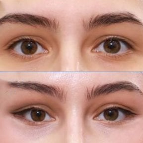 Результати блефаропластики до і після в Returning Plastic Surgery, корекція повік