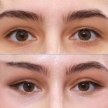 Результати блефаропластики до і після в Returning Plastic Surgery, корекція повік