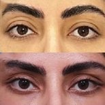 Результати блефаропластики до і після в Returning Plastic Surgery, корекція повік