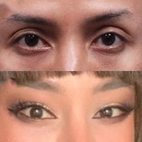 Результати блефаропластики до і після в Returning Plastic Surgery, корекція повік