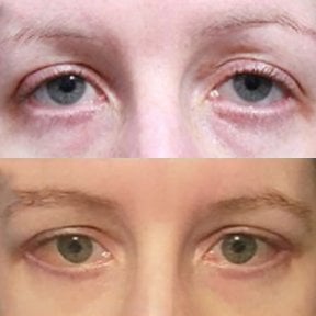 Результати блефаропластики до і після в Returning Plastic Surgery, корекція повік