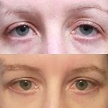 Результати блефаропластики до і після в Returning Plastic Surgery, корекція повік