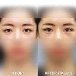 Блефаропластика до і після в Returning Plastic Surgery, результат корекції повік