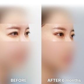 Блефаропластика до та після в Returning Plastic Surgery, результат корекції повік