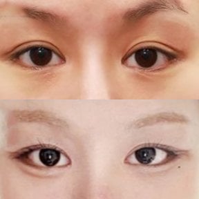 Результати до і після Fox Eye Lift у Returning Plastic Surgery, помітний піднятий контур очей