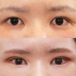 Результати до і після Fox Eye Lift у Returning Plastic Surgery, підняті повіки