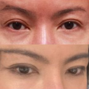Результати до і після Fox Eye Lift у Returning Plastic Surgery, піднятий контур очей