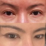 Результати до і після Fox Eye Lift у Returning Plastic Surgery, піднятий контур очей