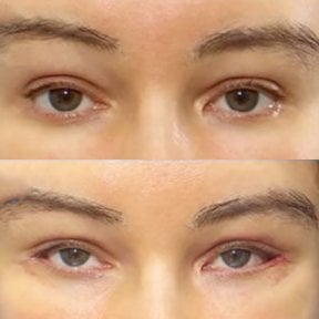 Результати до і після Fox Eye Lift у Returning Plastic Surgery, покращений контур очей