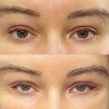 Результати до і після Fox Eye Lift у Returning Plastic Surgery, покращений контур очей