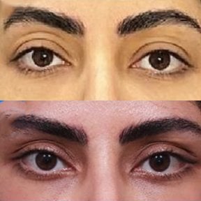 Результати до і після Fox Eye Lift у Returning Plastic Surgery, помітний ліфтинг очей