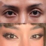 Результати до і після Fox Eye Lift у Returning Plastic Surgery, покращена форма очей