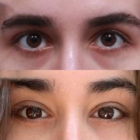 Результати до і після Fox Eye Lift у Returning Plastic Surgery, покращений контур очей