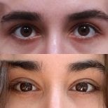 Результати до і після Fox Eye Lift у Returning Plastic Surgery, покращений контур очей
