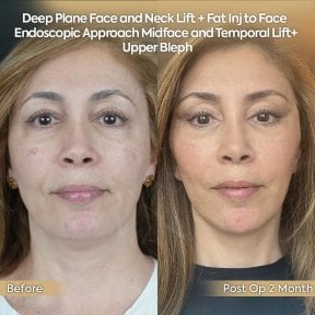 Результаты до и после deep plane SMAS лифтинга и подтяжки шеи в клинике Dr. Safa Manav