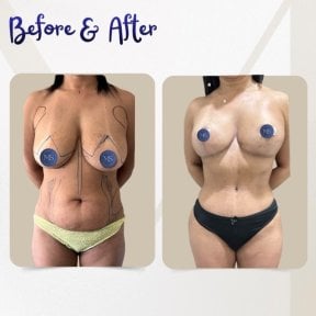 before-after photo liposuction