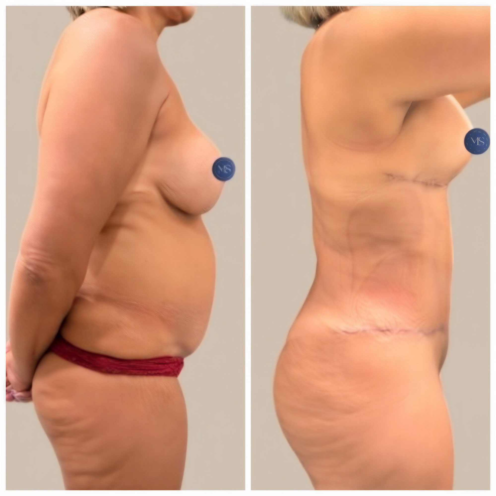 نتائج شفط الدهون قبل وبعد في عيادة Dr. Michel Salameh - Plastic And Aesthetic Surgery
