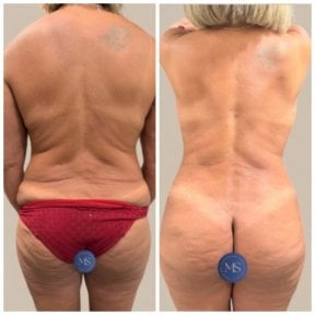 before-after photo liposuction