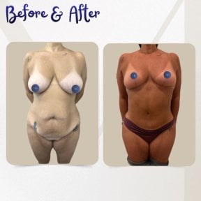 before-after photo liposuction