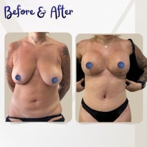 before-after photo liposuction