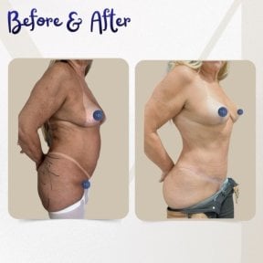before-after photo liposuction
