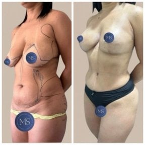 before-after photo liposuction