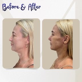 before-after photo blepharoplasty-eyelid