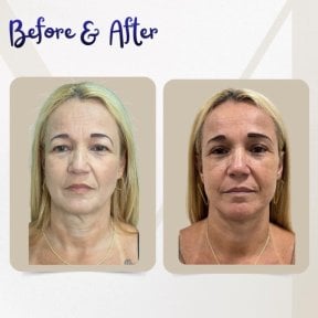 before-after photo blepharoplasty-eyelid