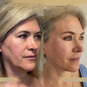 Before and after neck lift results at Dr. Safa Manav Clinic, visible jawline and neck contour