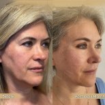 Before and after neck lift results at Dr. Safa Manav Clinic, visible jawline and neck contour