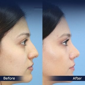 before-after photo rhinoplasty-nose-job