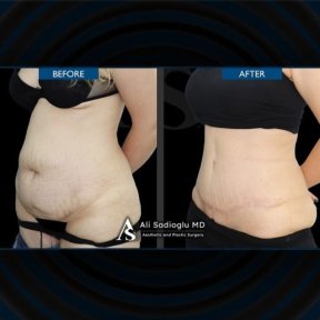 before-after photo abdominoplastika