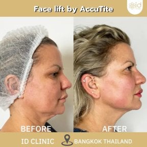 before-after photo rhinoplasty-nose-job