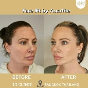 before-after photo rhinoplasty-nose-job