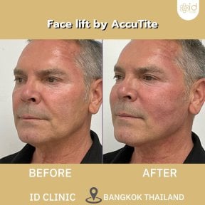 before-after photo rhinoplasty-nose-job