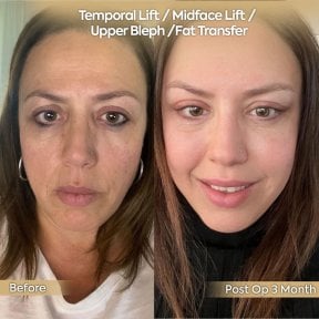 before-after photo facial-fat-transfer