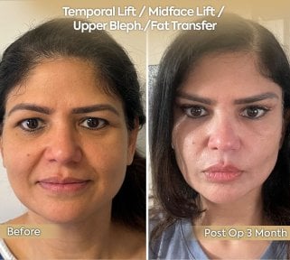 before-after photo facial-fat-transfer