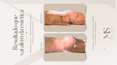 before-after photo post-bariatric-plastic-surgery