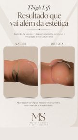 before-after photo post-bariatric-plastic-surgery