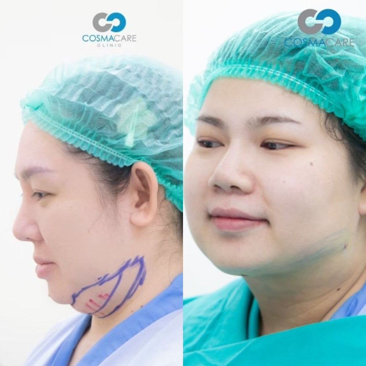 نتيجة شفط دهون الذقن قبل وبعد في Cosmacare Clinic Center for Aesthetic Medicine