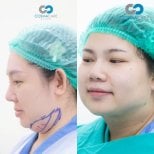 Résultat avant-après liposuccion du menton chez Cosmacare Clinic Center for Aesthetic Medicine