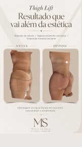 before-after photo abdominal-liposuction